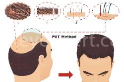 hair transplant fut method
