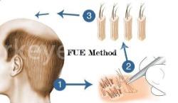 hair transplant fue method